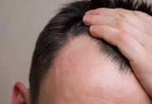 چرا هزینه کاشت مو در ایران نسبت به سایر کشورها کمتر است؟
