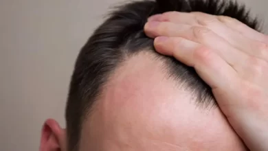 چرا هزینه کاشت مو در ایران نسبت به سایر کشورها کمتر است؟