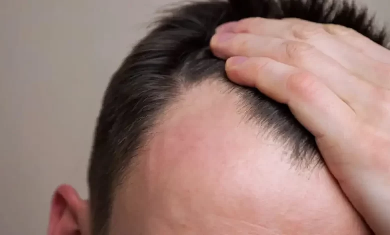 چرا هزینه کاشت مو در ایران نسبت به سایر کشورها کمتر است؟