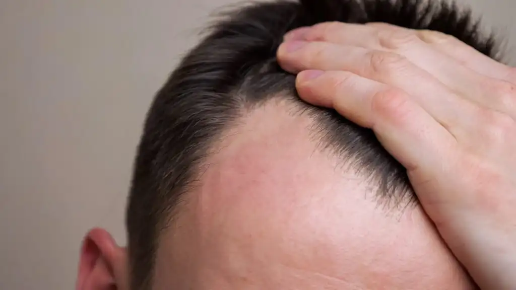چرا هزینه کاشت مو در ایران نسبت به سایر کشورها کمتر است؟
