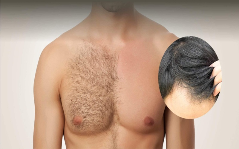 کاشت مو BHT؛ روشی نوین برای درمان ریزش مو با استفاده از موهای بدن