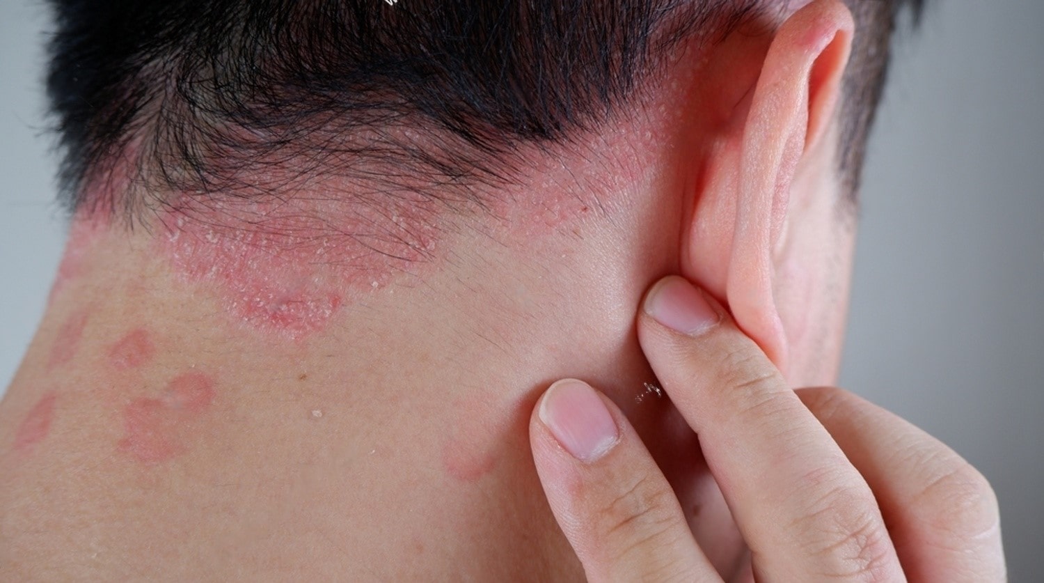 علت شوره، زخم و خارش پوست سر؛ دلایل و راهکارهای درمانی