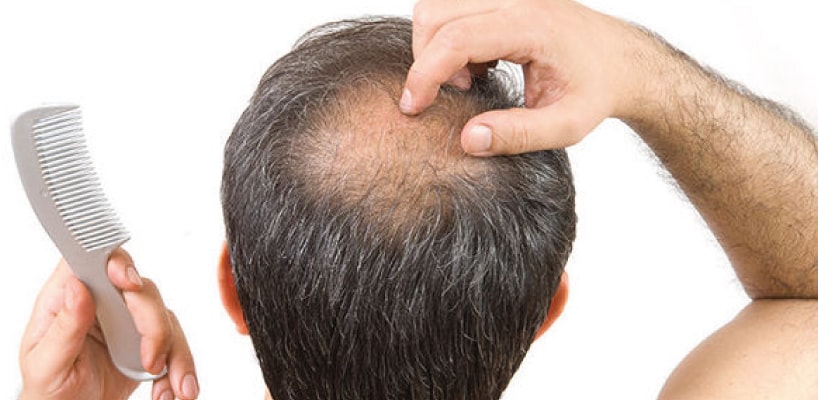 جلوگیری از کچلی؛ راهکارهای طبیعی، دارویی و تخصصی