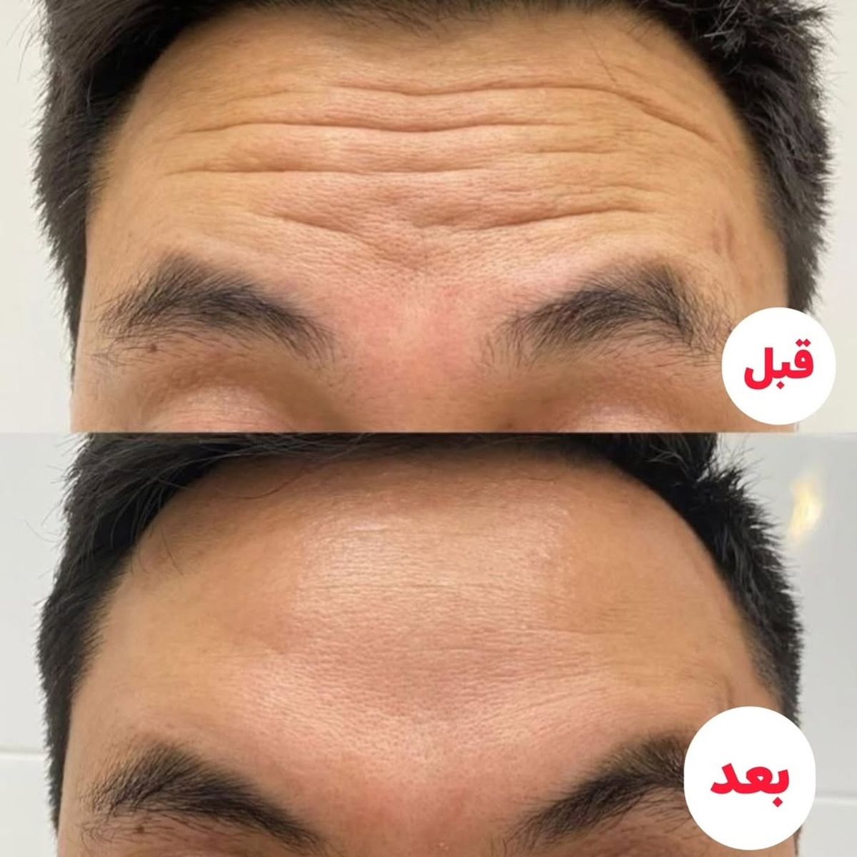 جوانسازی پوست پیشانی: راز بازگشت جوانی به ناحیه‌ای که زودتر پیر می‌شود!