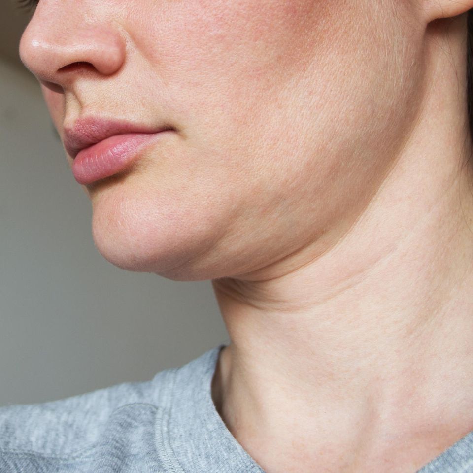 ساکشن غبغب چیست؟ راهکاری مؤثر برای حذف چربی زیر چانه و فرم‌دهی صورت
