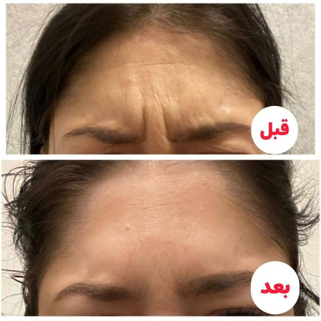 جوانسازی پوست پیشانی