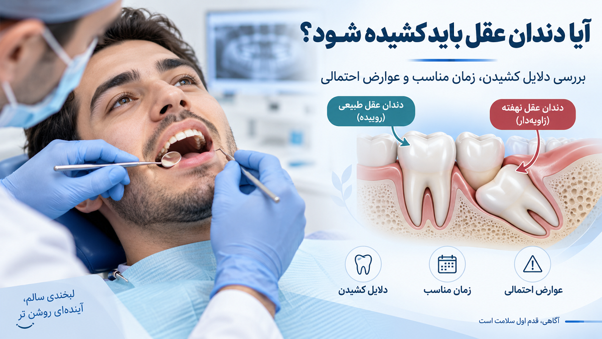 آیا دندان عقل باید کشیده شود؟ بررسی دلایل کشیدن، زمان مناسب و عوارض احتمالی