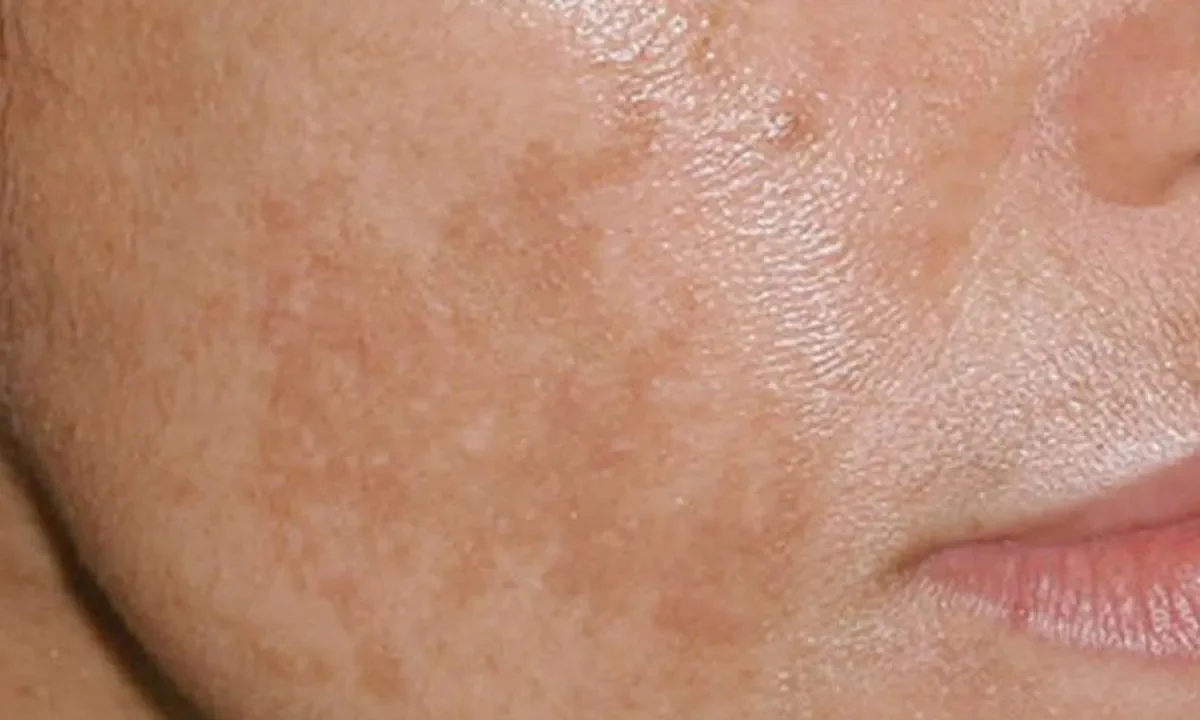 علت لک روی گونه چیست؟ بررسی ۸ دلیل اصلی + راه درمان
