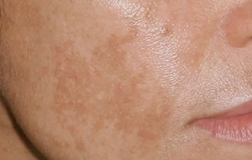 علت لک روی گونه چیست؟ بررسی ۸ دلیل اصلی + راه درمان