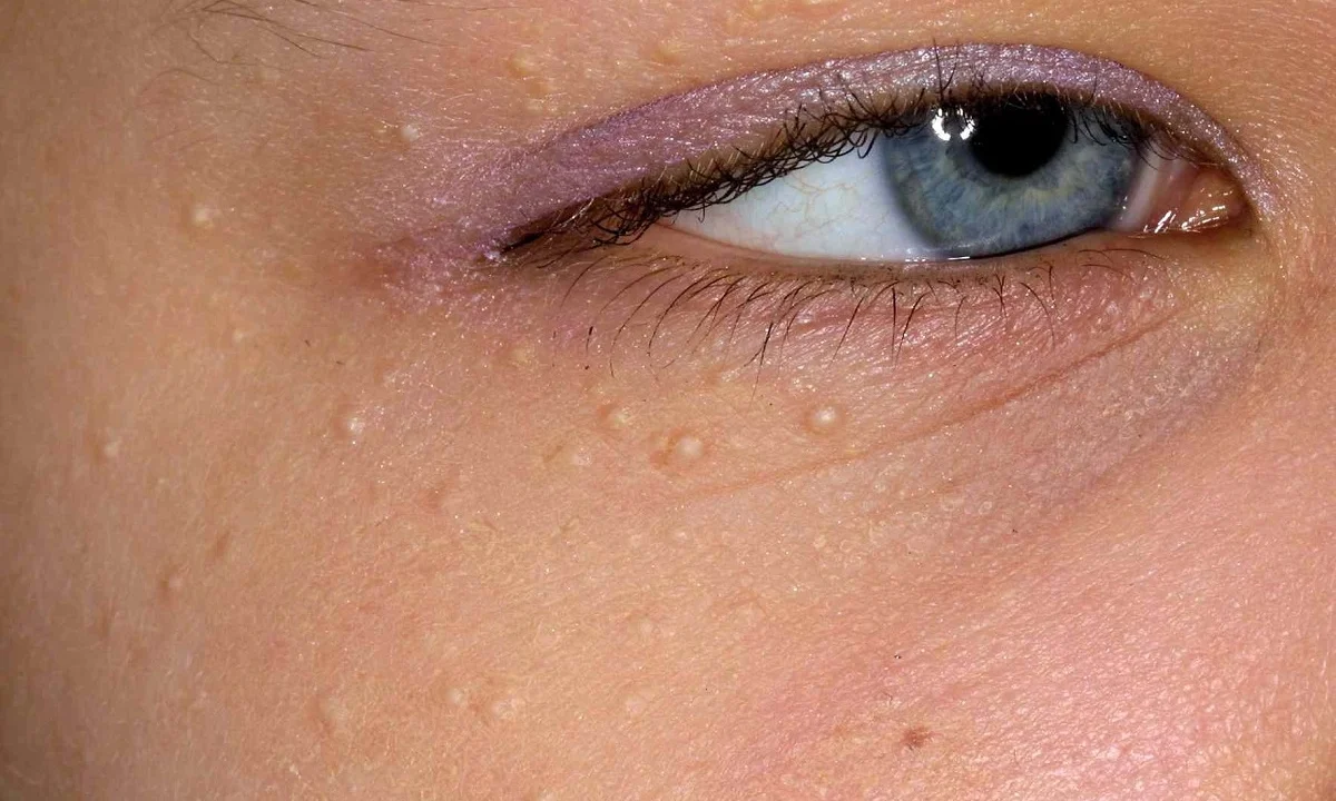 علت میلیا زیر چشم در کودکان؛ آیا نیاز به درمان دارد؟