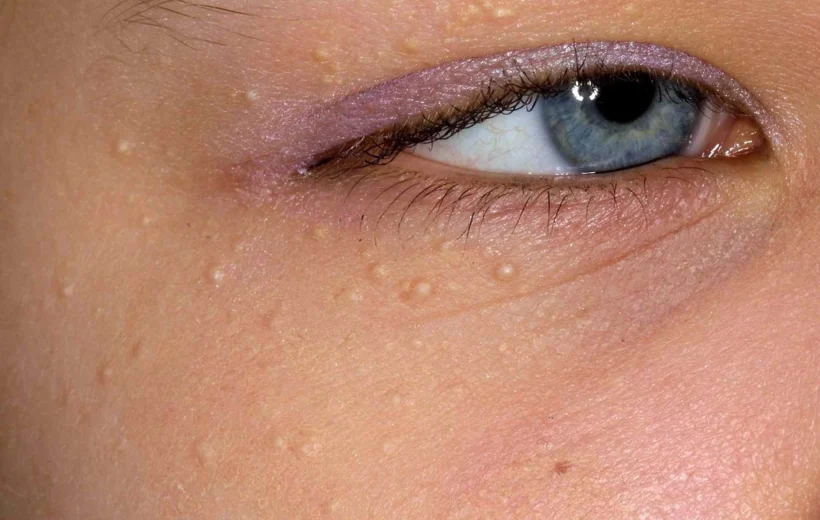 علت میلیا زیر چشم در کودکان؛ آیا نیاز به درمان دارد؟